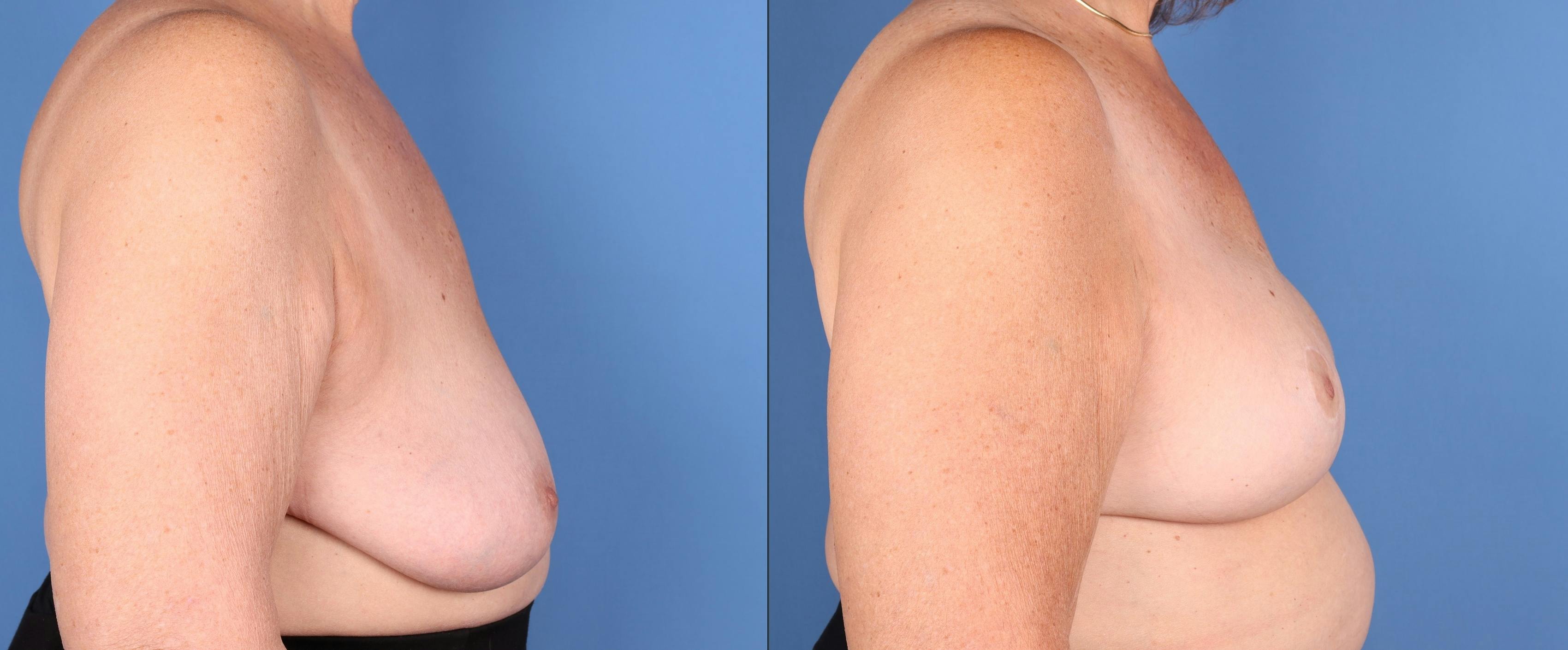 Breast Augmentation Before & After Gallery - Patient 656455 - Image 2