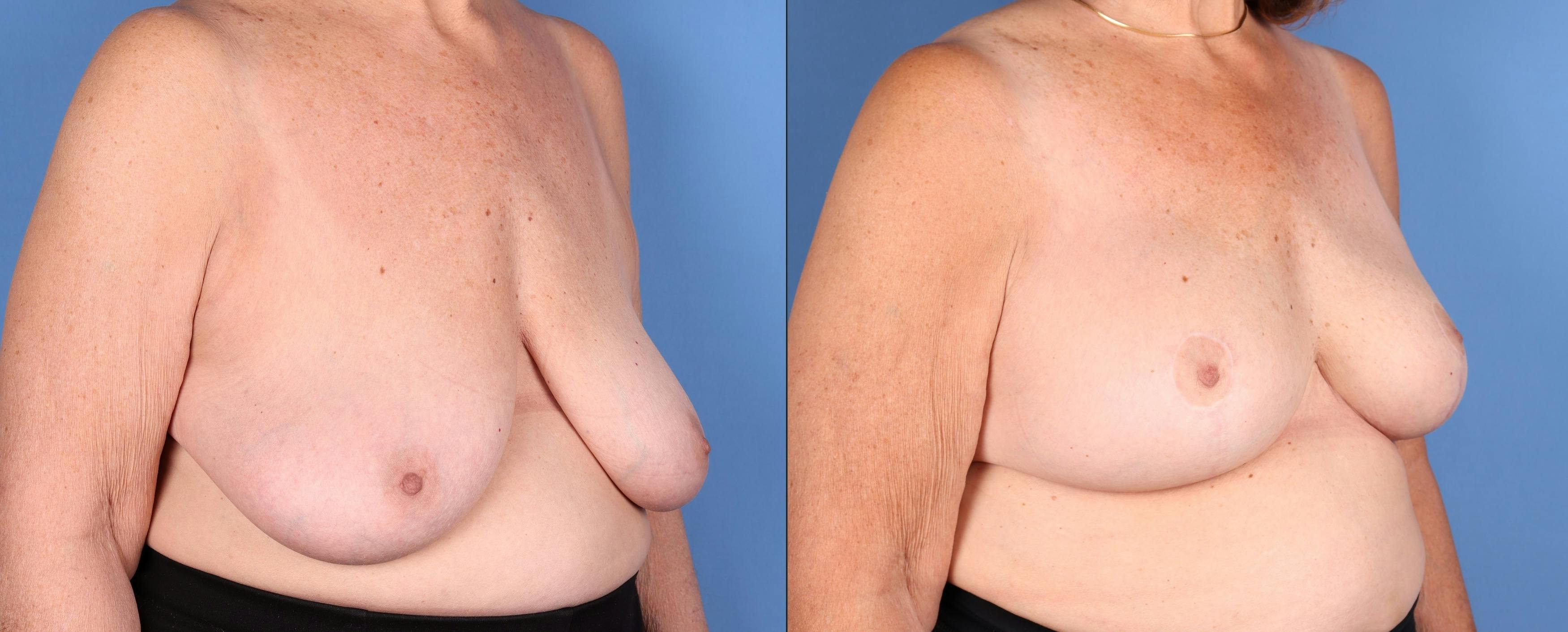 Breast Augmentation Before & After Gallery - Patient 656455 - Image 3
