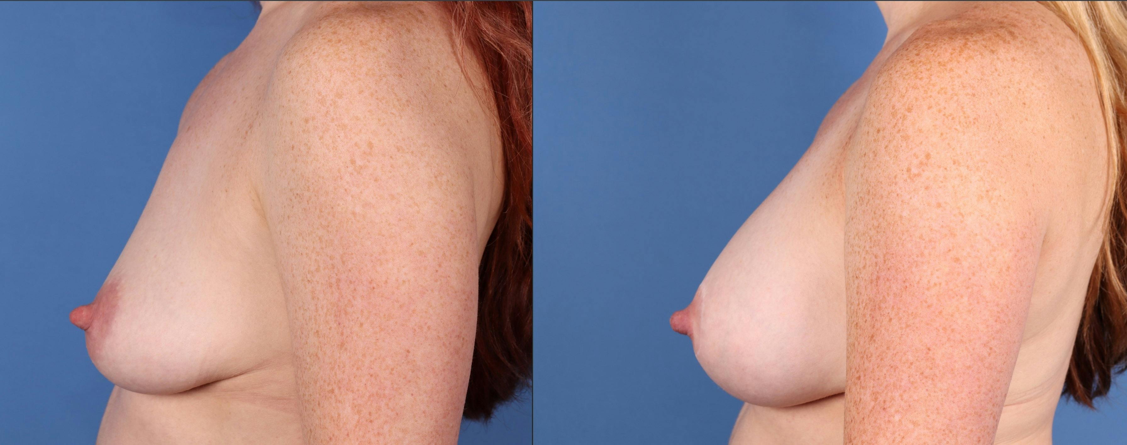 Breast Lift Before & After Gallery - Patient 199760 - Image 3