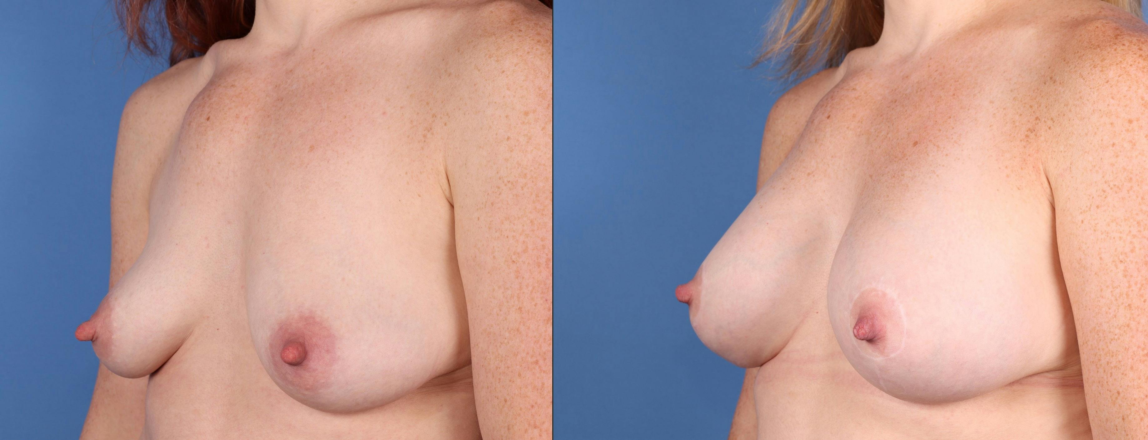 Breast Lift Before & After Gallery - Patient 199760 - Image 2