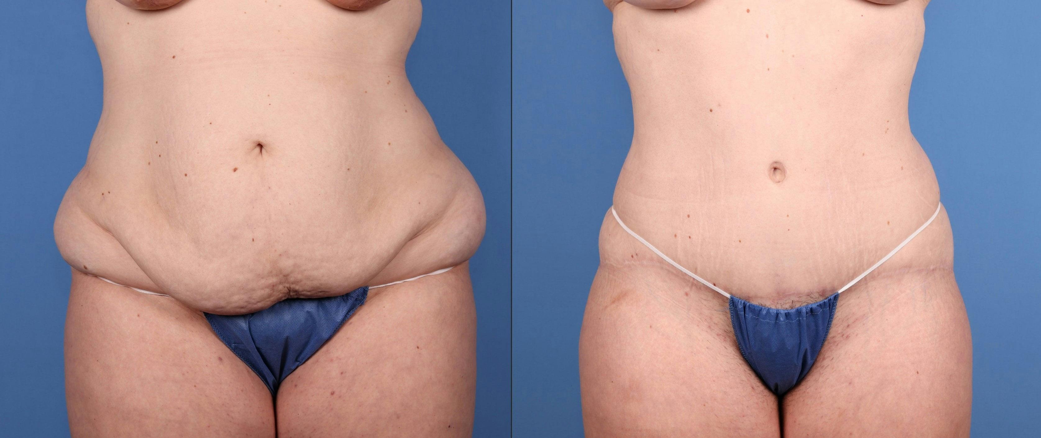 Abdomen Before & After Gallery - Patient 918705 - Image 1