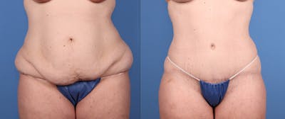 Abdomen Before & After Gallery - Patient 918705 - Image 1