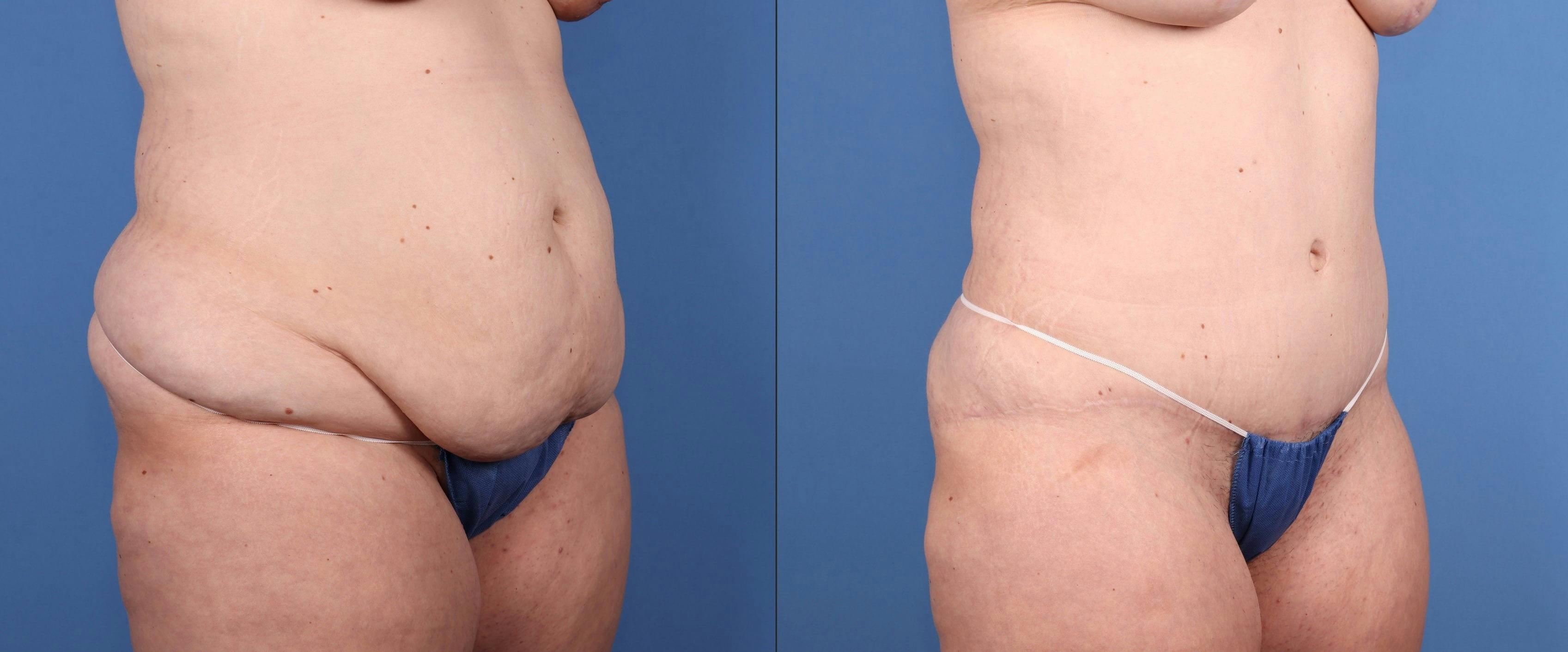 Abdomen Before & After Gallery - Patient 918705 - Image 2