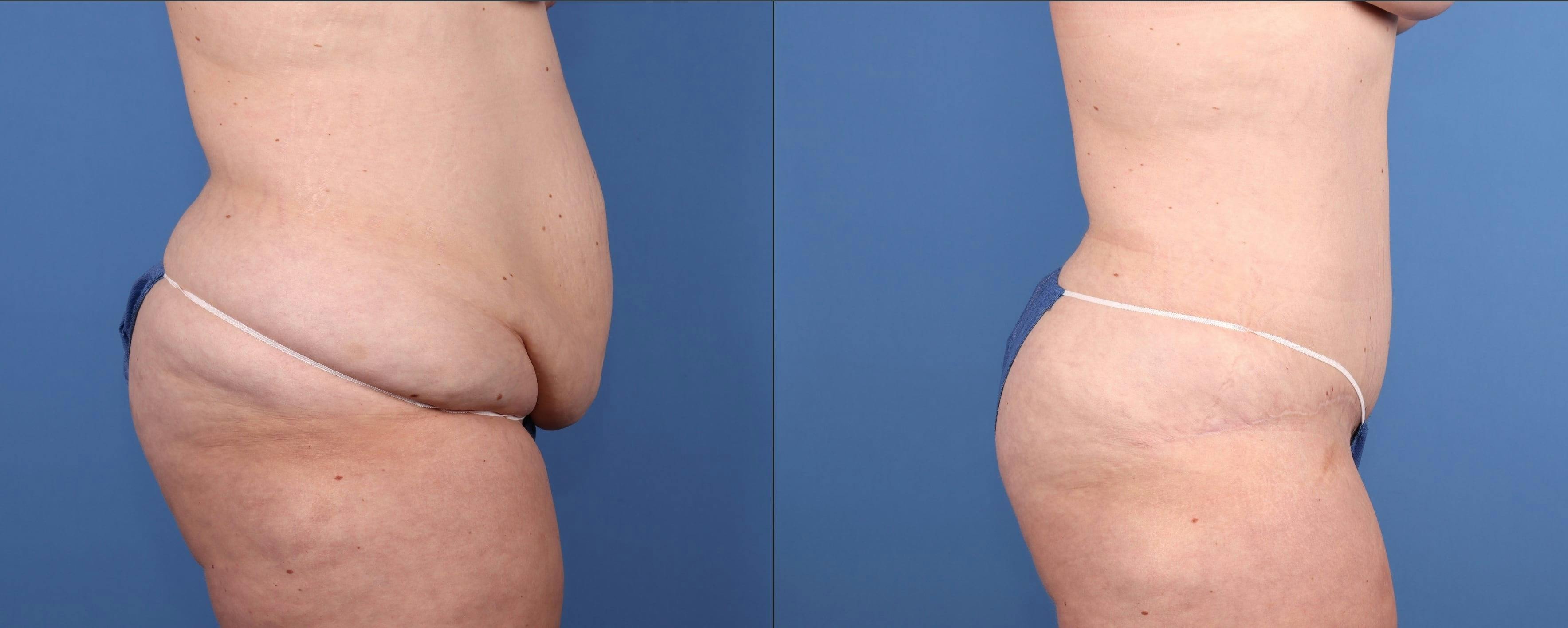 Abdomen Before & After Gallery - Patient 918705 - Image 3