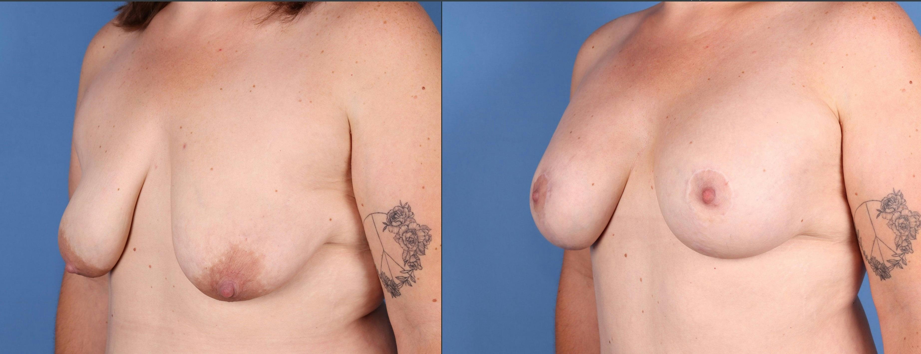 Breast Lift with Augmentation Before & After Gallery - Patient 154047 - Image 2