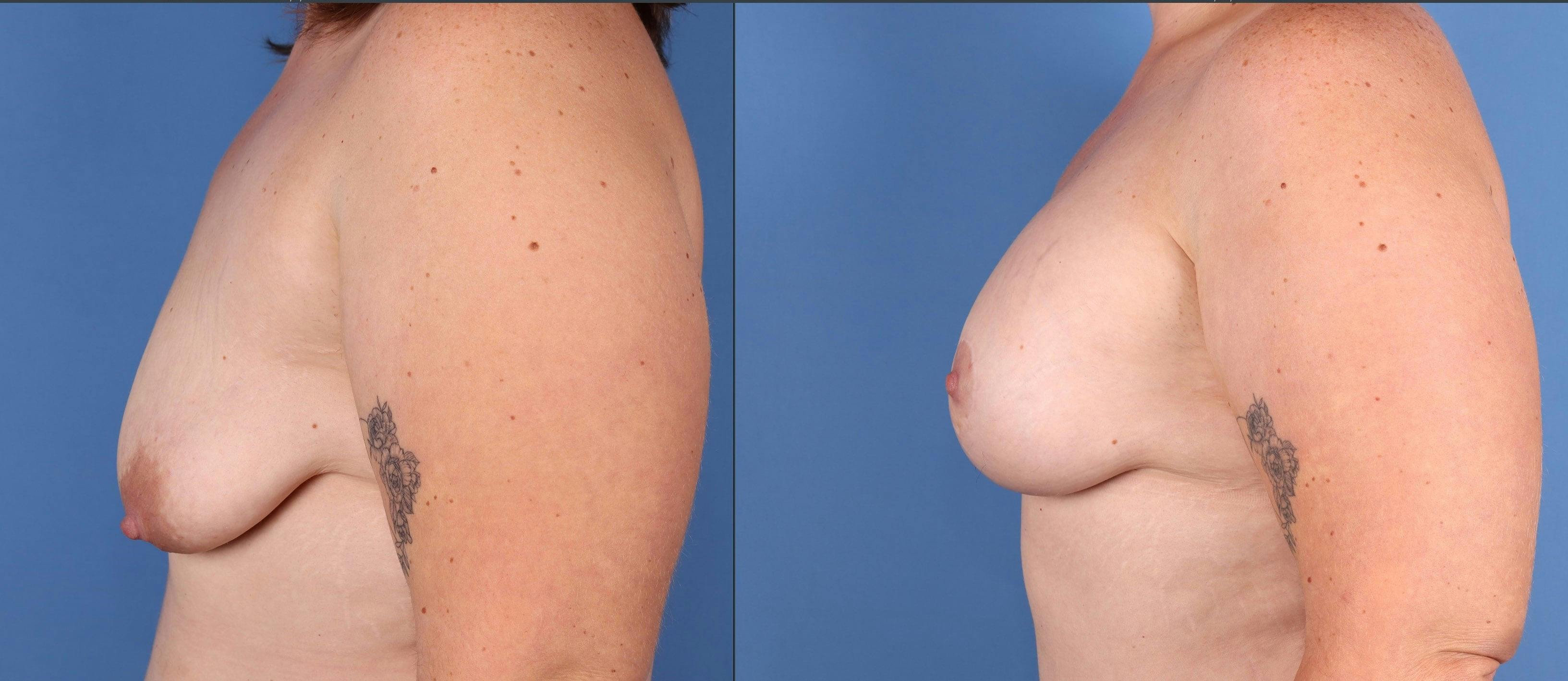 Breast Lift with Augmentation Before & After Gallery - Patient 154047 - Image 3