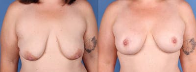 Breast Lift with Augmentation Before & After Gallery - Patient 154047 - Image 1