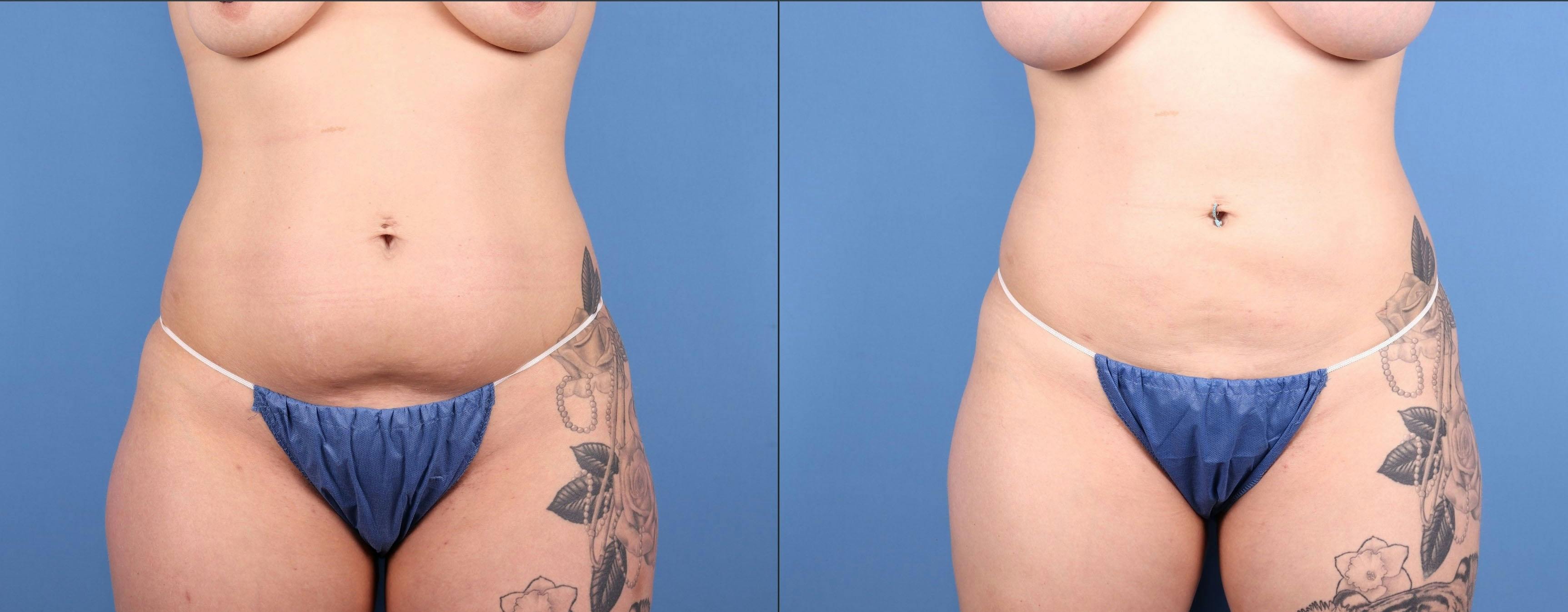 Abdomen Before & After Gallery - Patient 219446 - Image 1