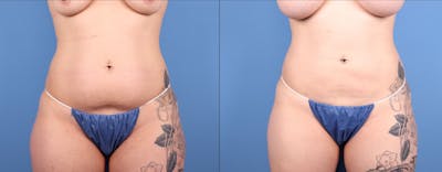 Abdomen Before & After Gallery - Patient 219446 - Image 1