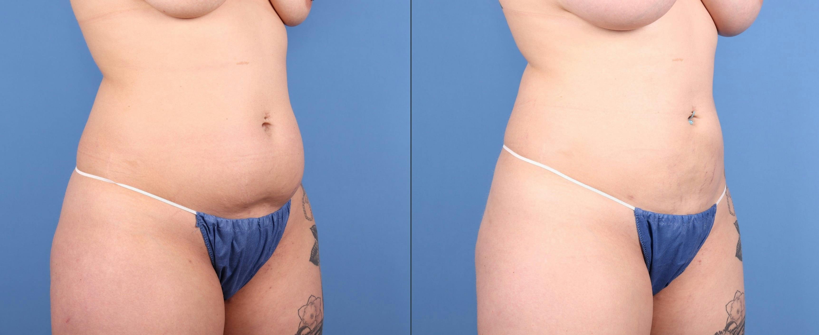 Abdomen Before & After Gallery - Patient 219446 - Image 2