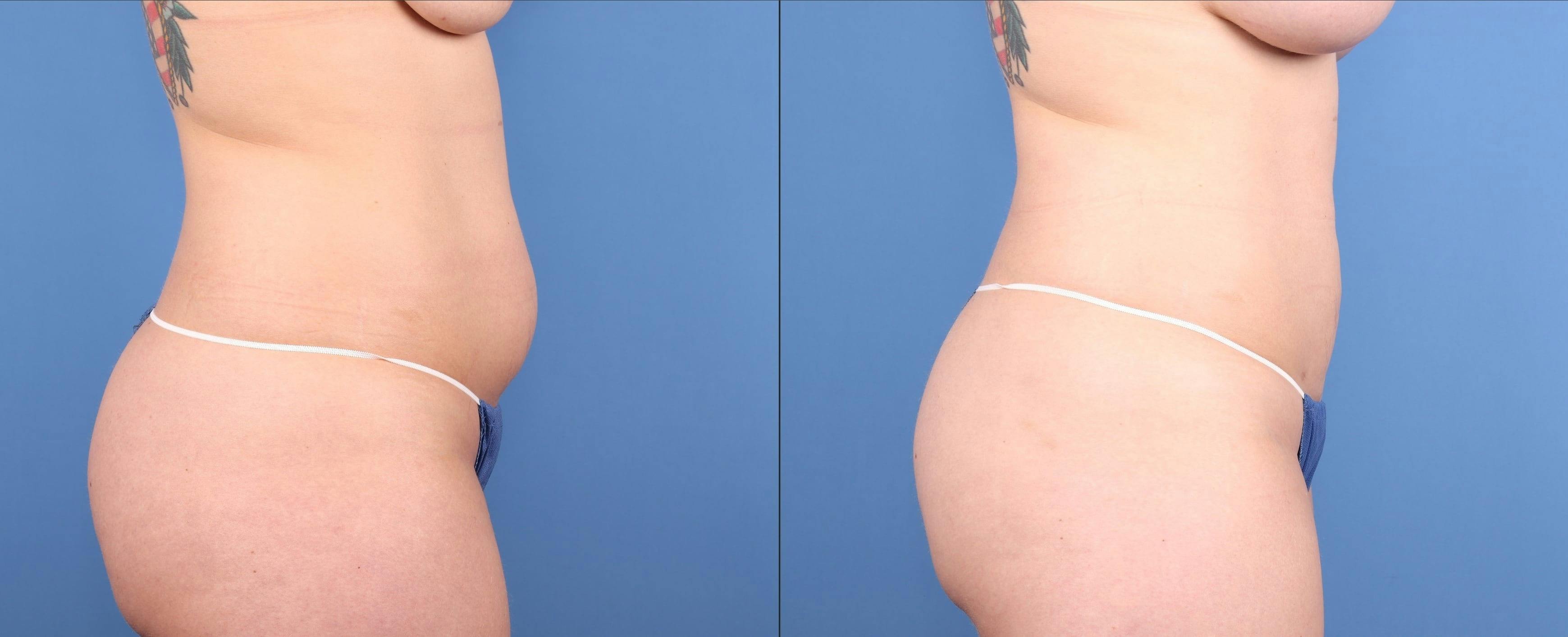 Abdomen Before & After Gallery - Patient 219446 - Image 3