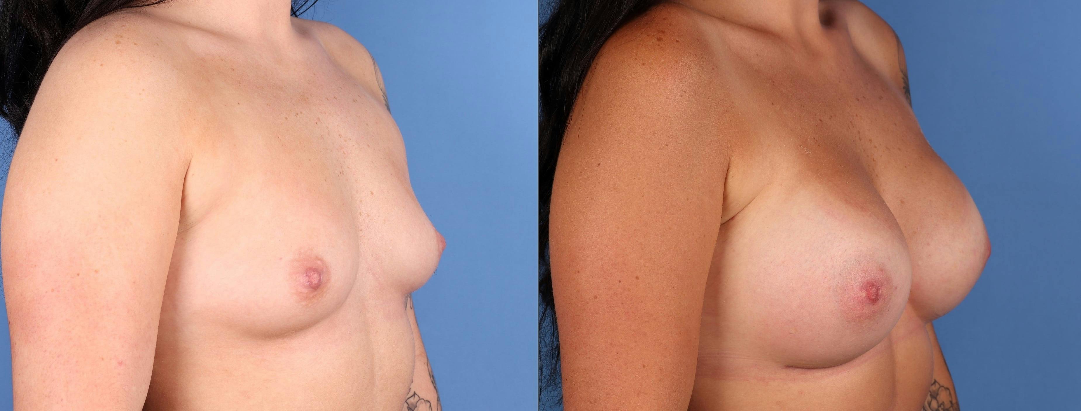 Breast Augmentation Before & After Gallery - Patient 790180 - Image 5