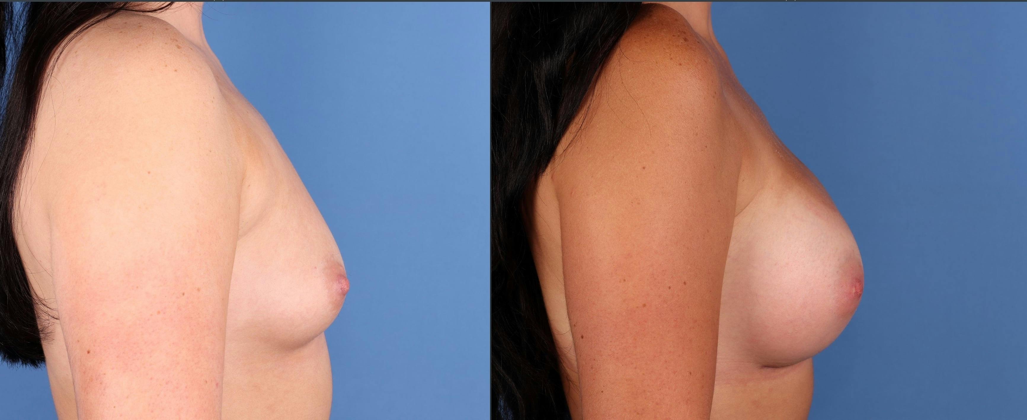 Breast Augmentation Before & After Gallery - Patient 790180 - Image 4