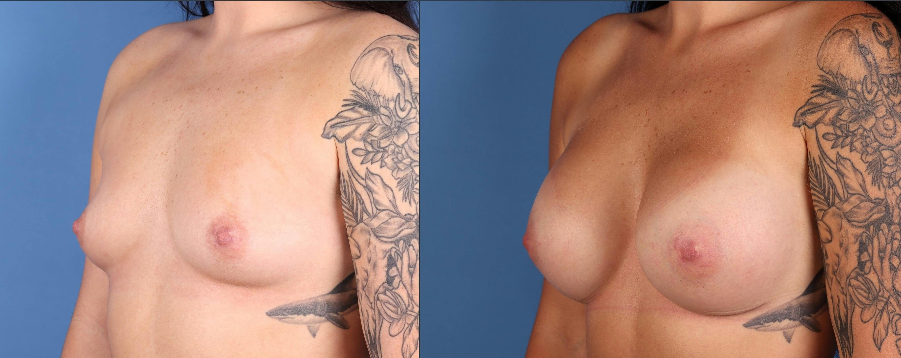 Breast Augmentation Before & After Gallery - Patient 790180 - Image 2