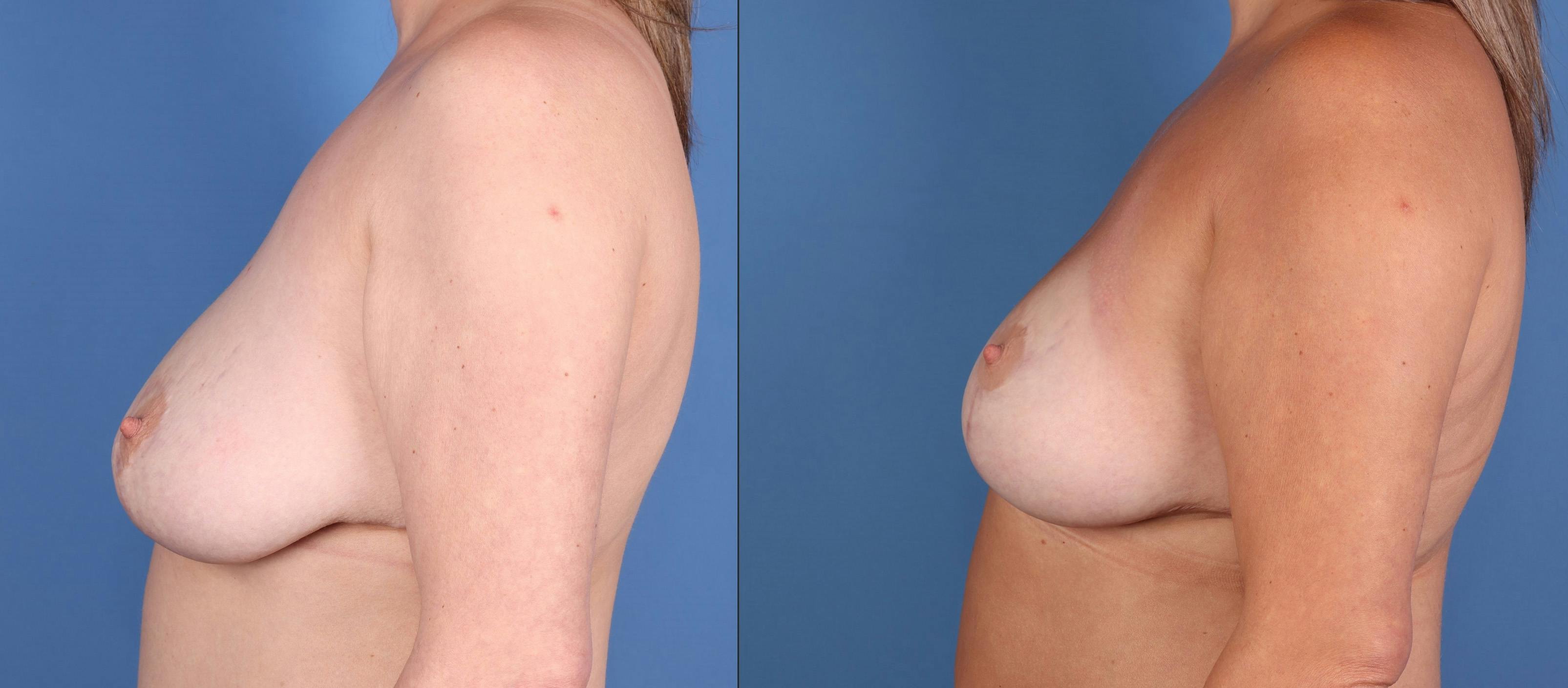 Breast Lift Before & After Gallery - Patient 304450 - Image 3