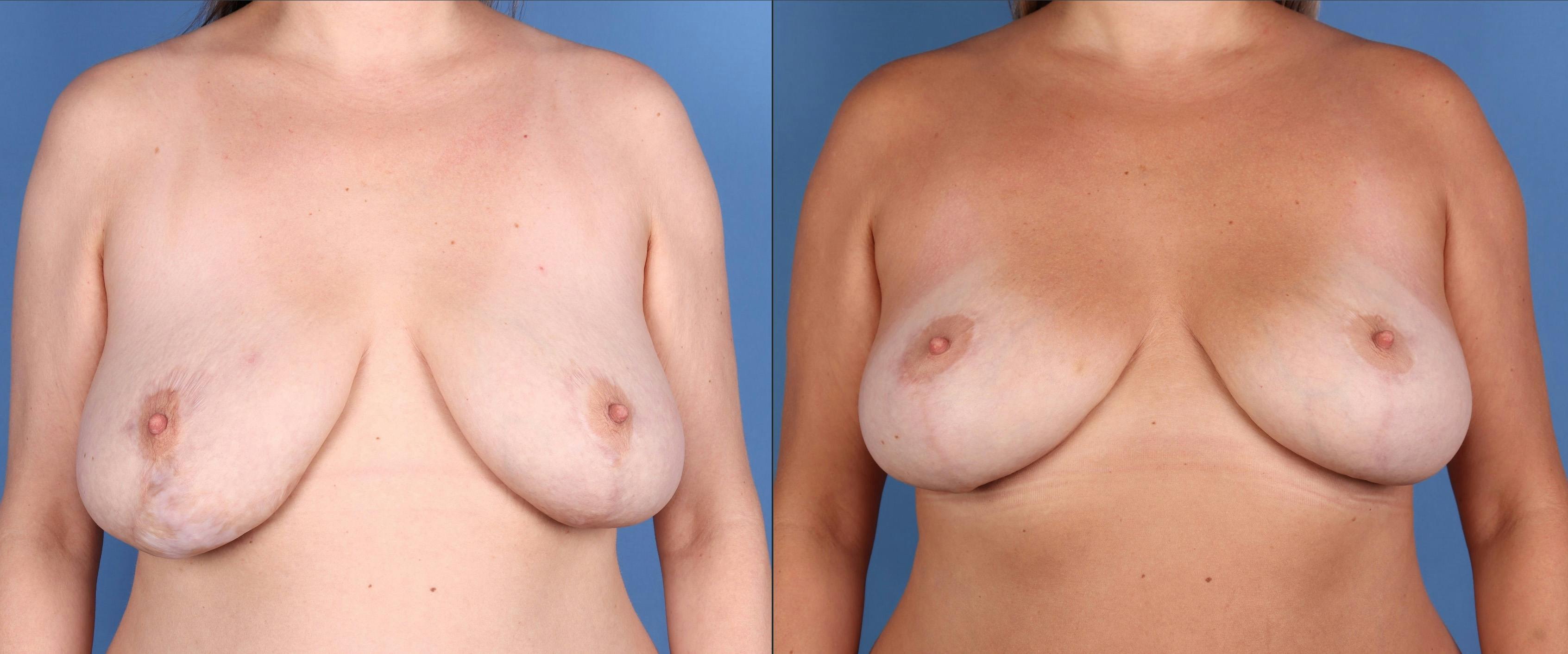 Breast Lift Before & After Gallery - Patient 304450 - Image 1