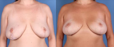 Breast Lift Before & After Gallery - Patient 304450 - Image 1