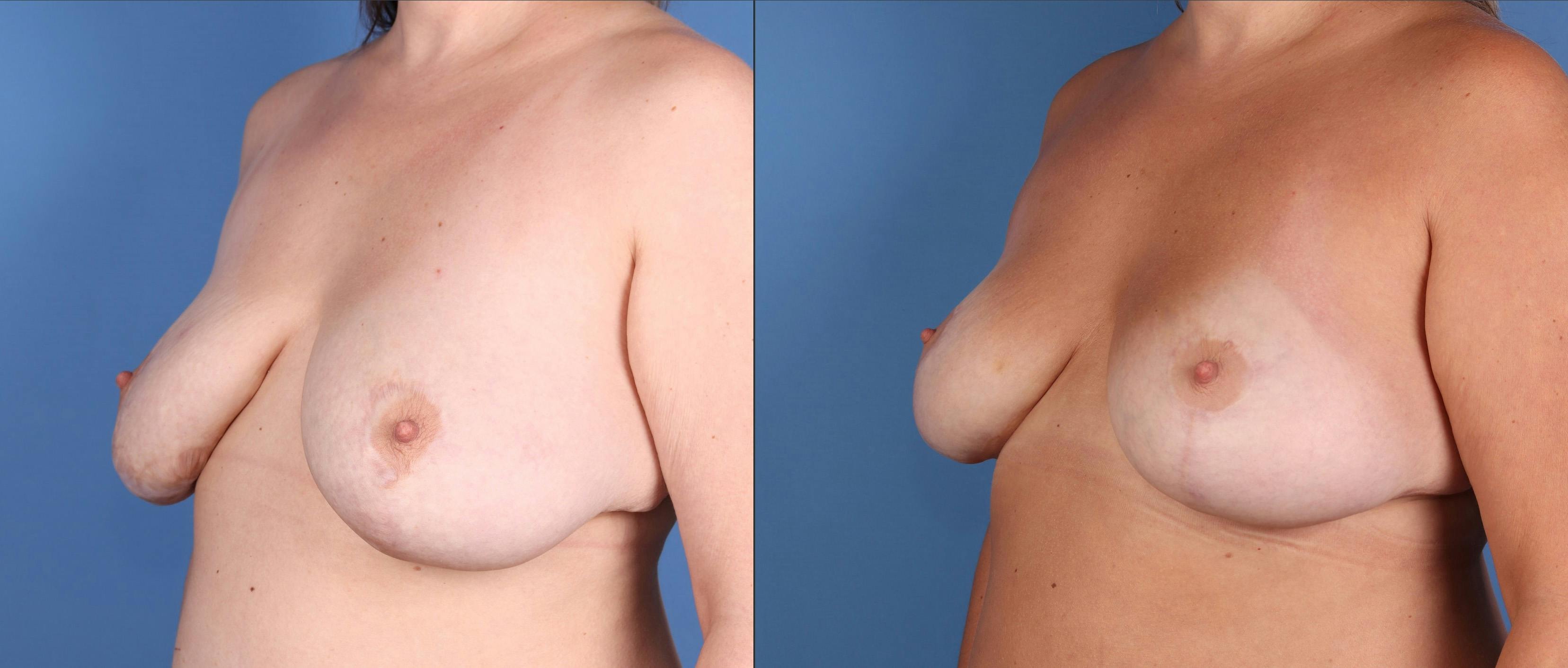 Breast Lift Before & After Gallery - Patient 304450 - Image 2
