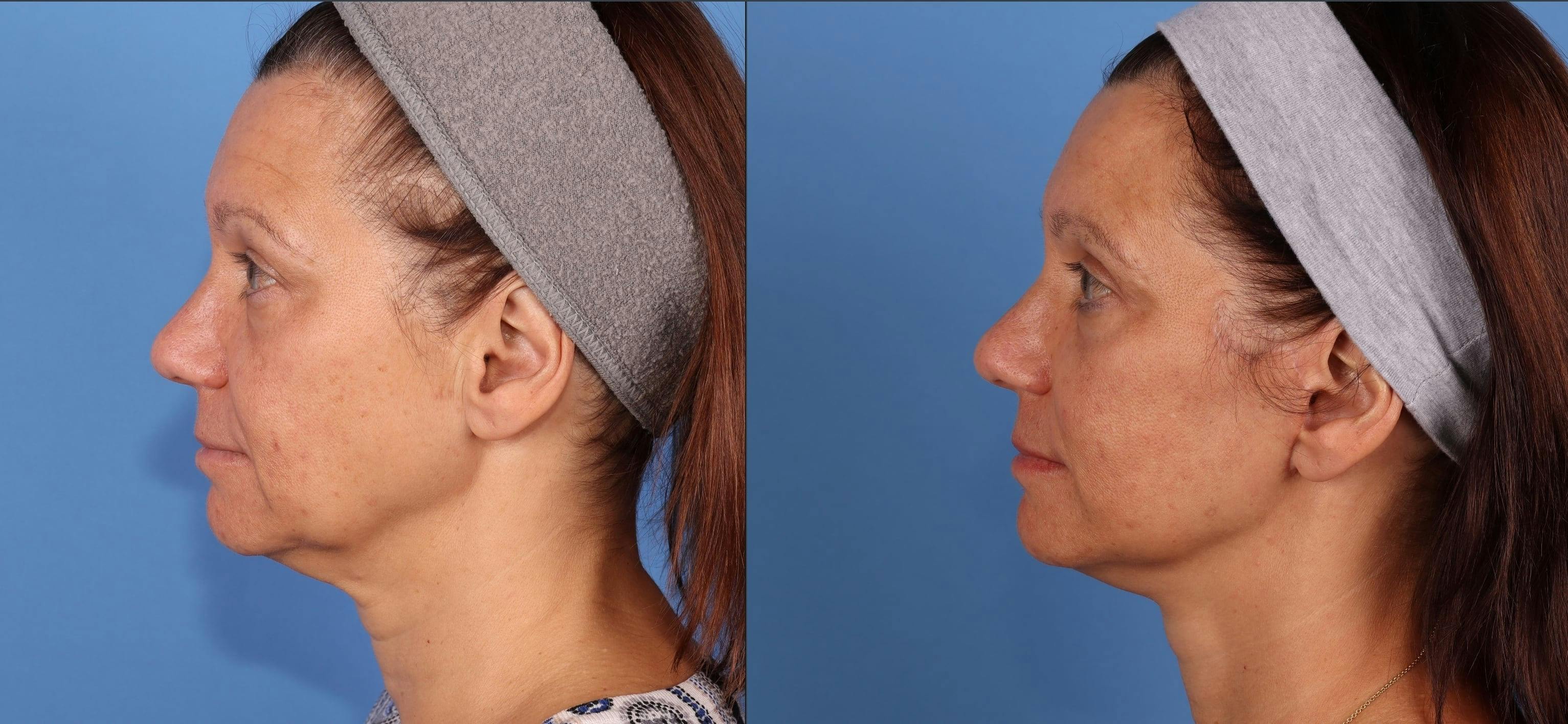 Eyelid Surgery (Upper Blepharoplasty) Before & After Gallery - Patient 339638 - Image 3