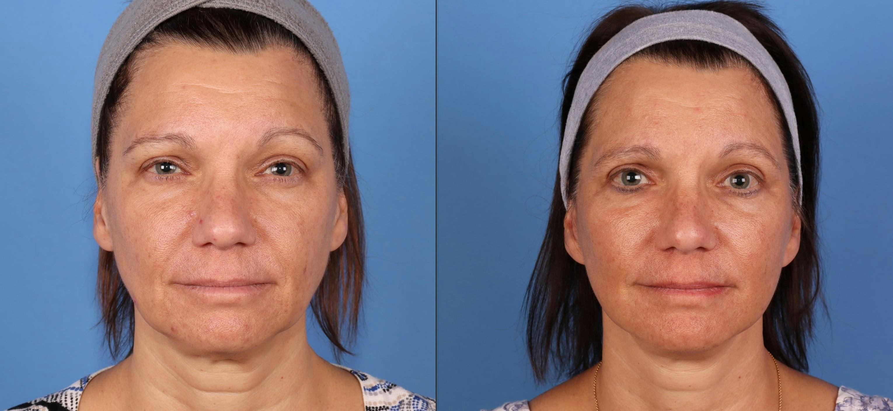 Facelift