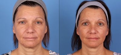Eyelid Surgery (Upper Blepharoplasty) Before & After Gallery - Patient 339638 - Image 1