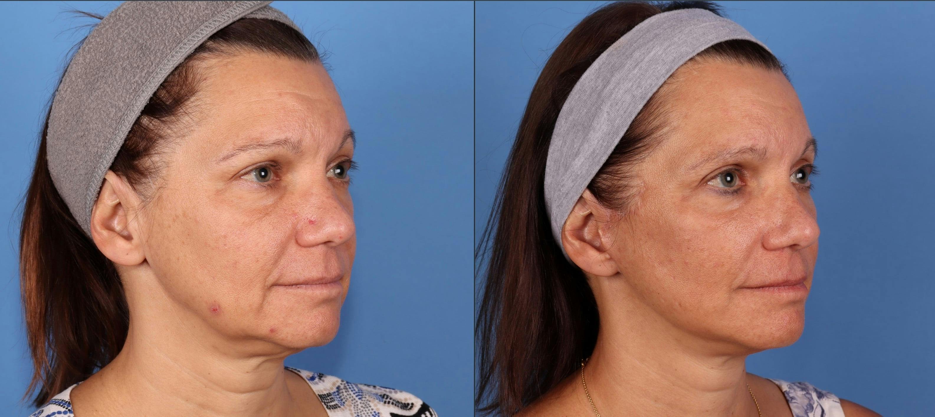 Eyelid Surgery (Upper Blepharoplasty) Before & After Gallery - Patient 339638 - Image 5