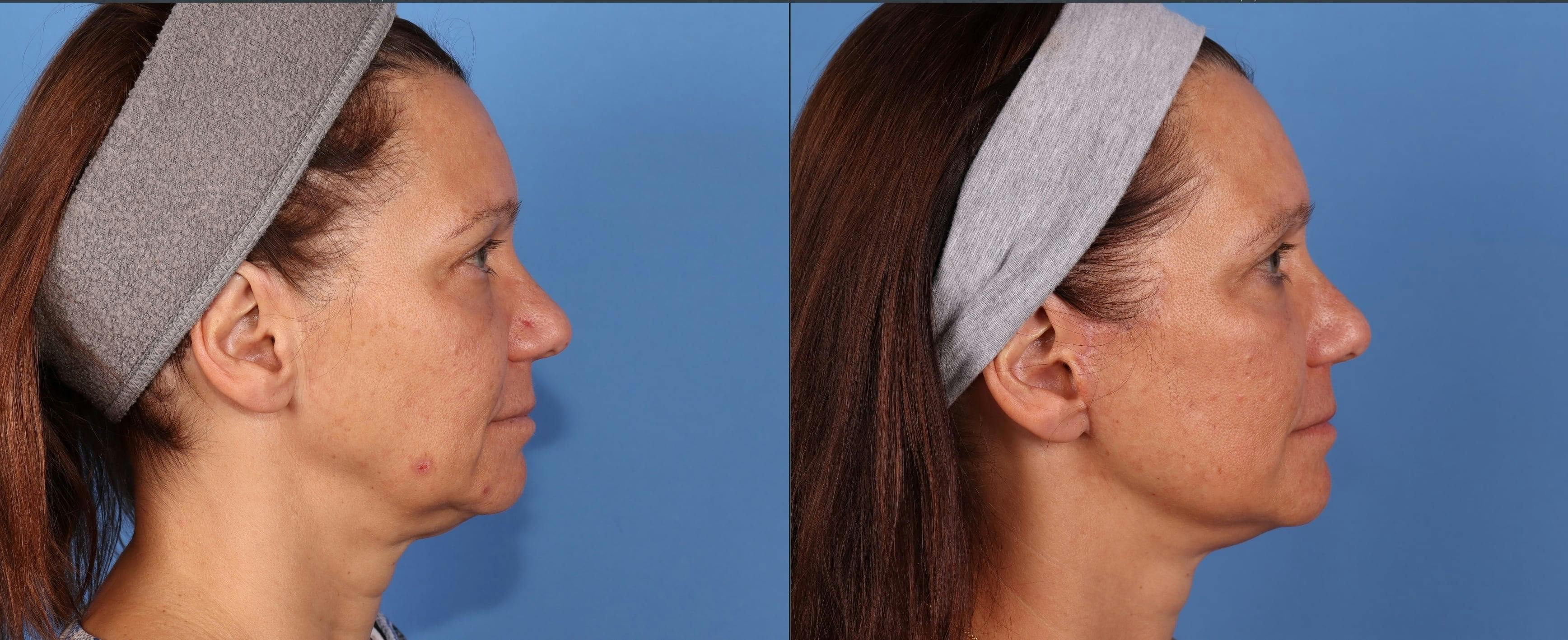 Eyelid Surgery (Upper Blepharoplasty) Before & After Gallery - Patient 339638 - Image 4