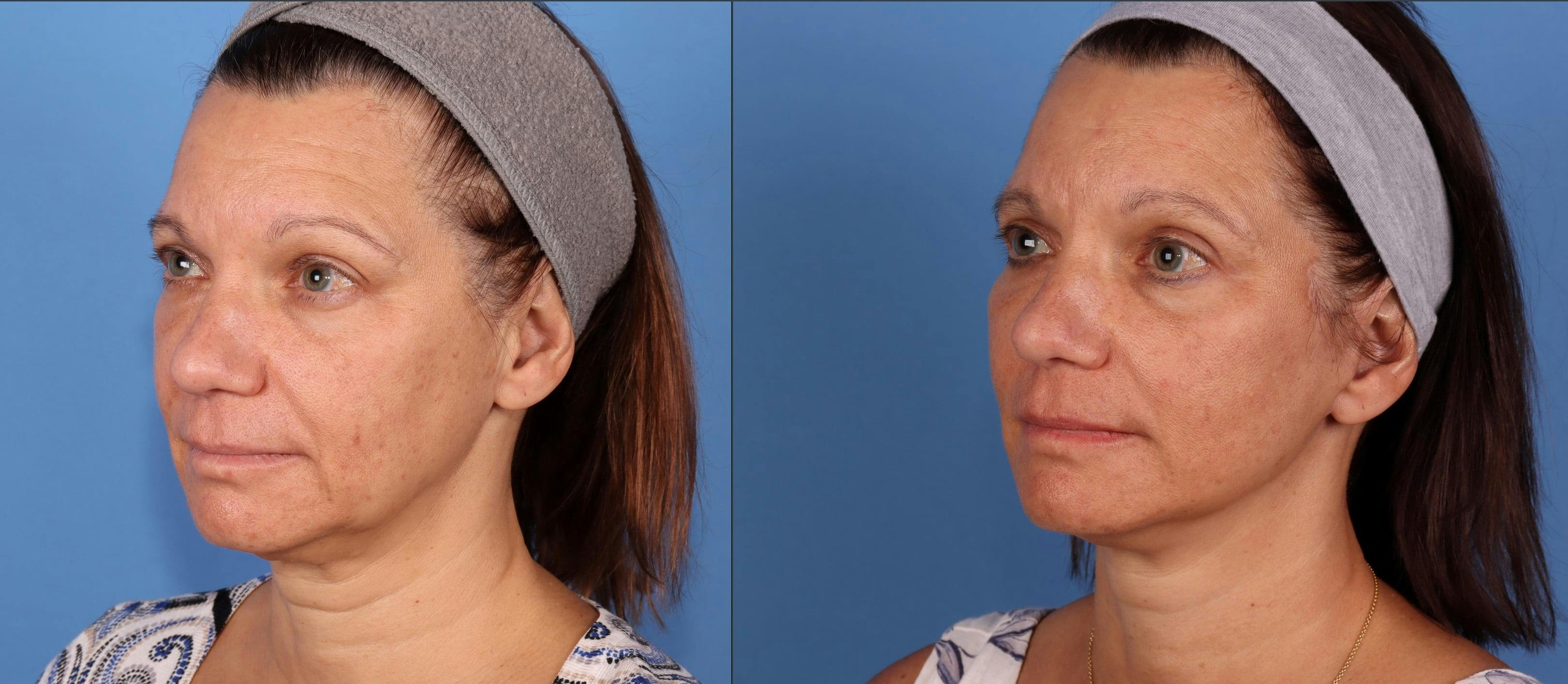 Eyelid Surgery (Upper Blepharoplasty) Before & After Gallery - Patient 339638 - Image 2