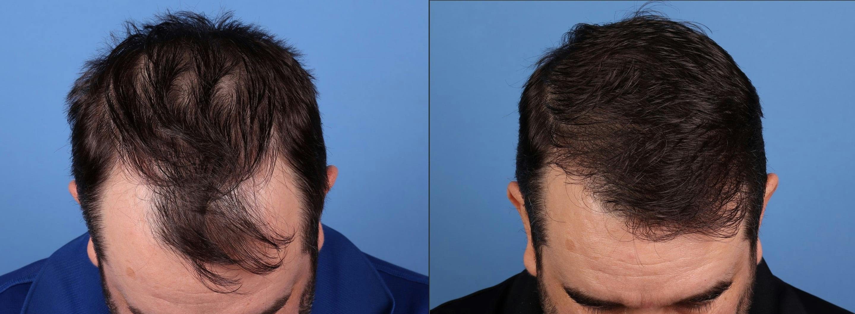 NeoGraft Hair Restoration Before & After Gallery - Patient 198834 - Image 1
