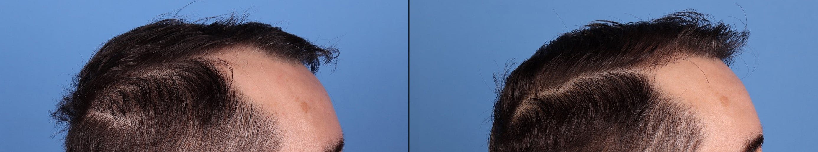 NeoGraft Hair Restoration Before & After Gallery - Patient 198834 - Image 3