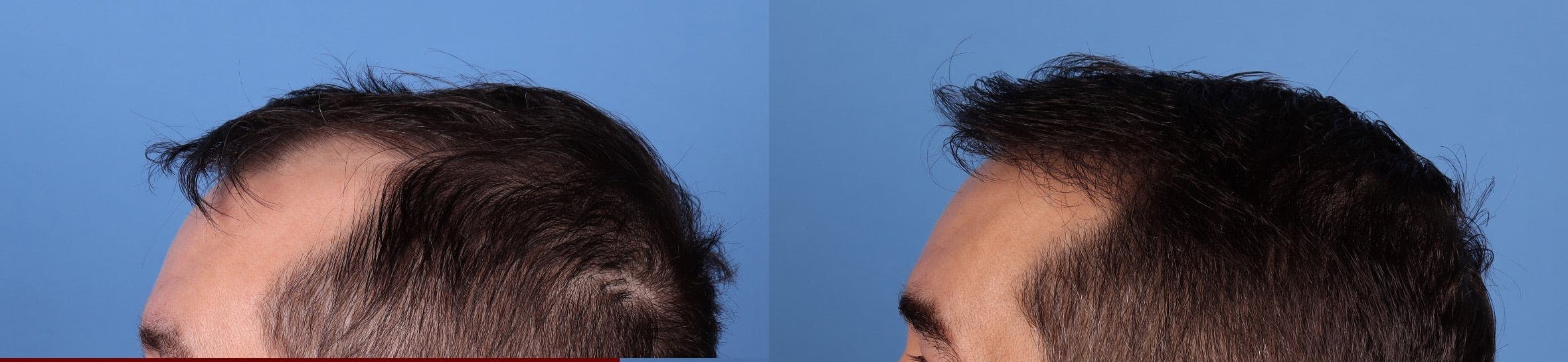 NeoGraft Hair Restoration Before & After Gallery - Patient 198834 - Image 4
