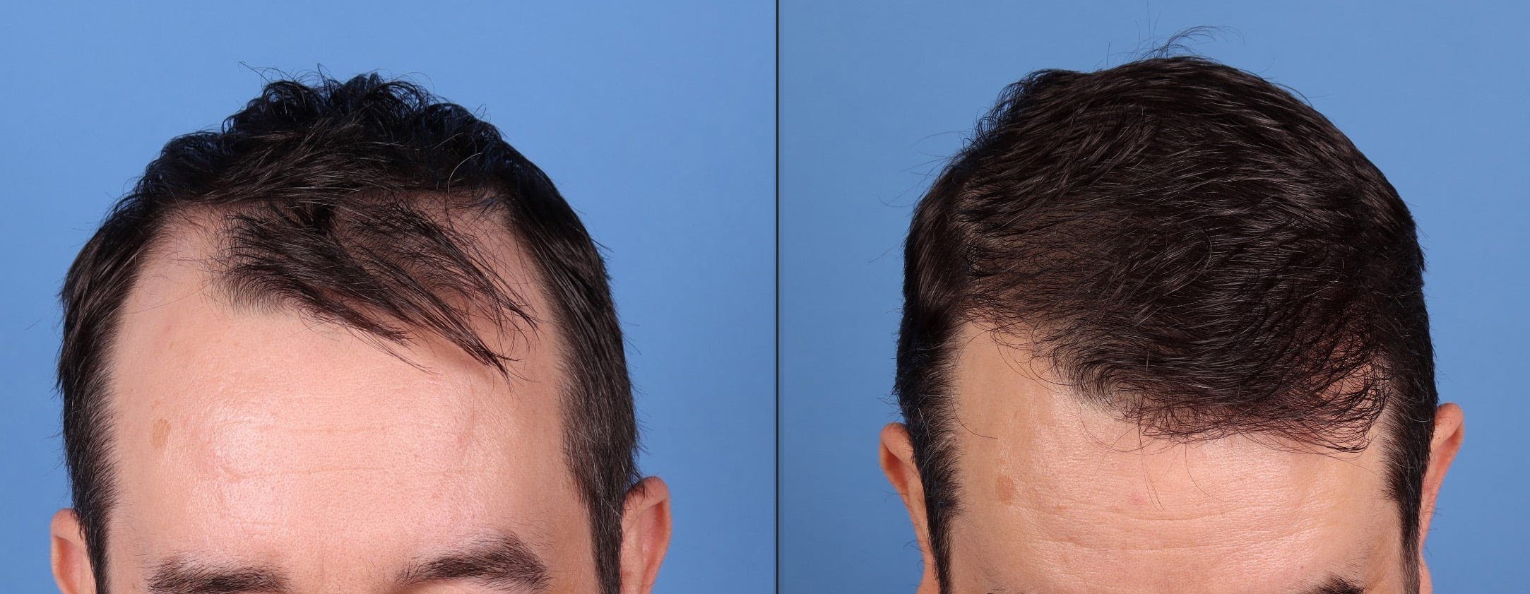 NeoGraft Hair Restoration Before & After Gallery - Patient 198834 - Image 2