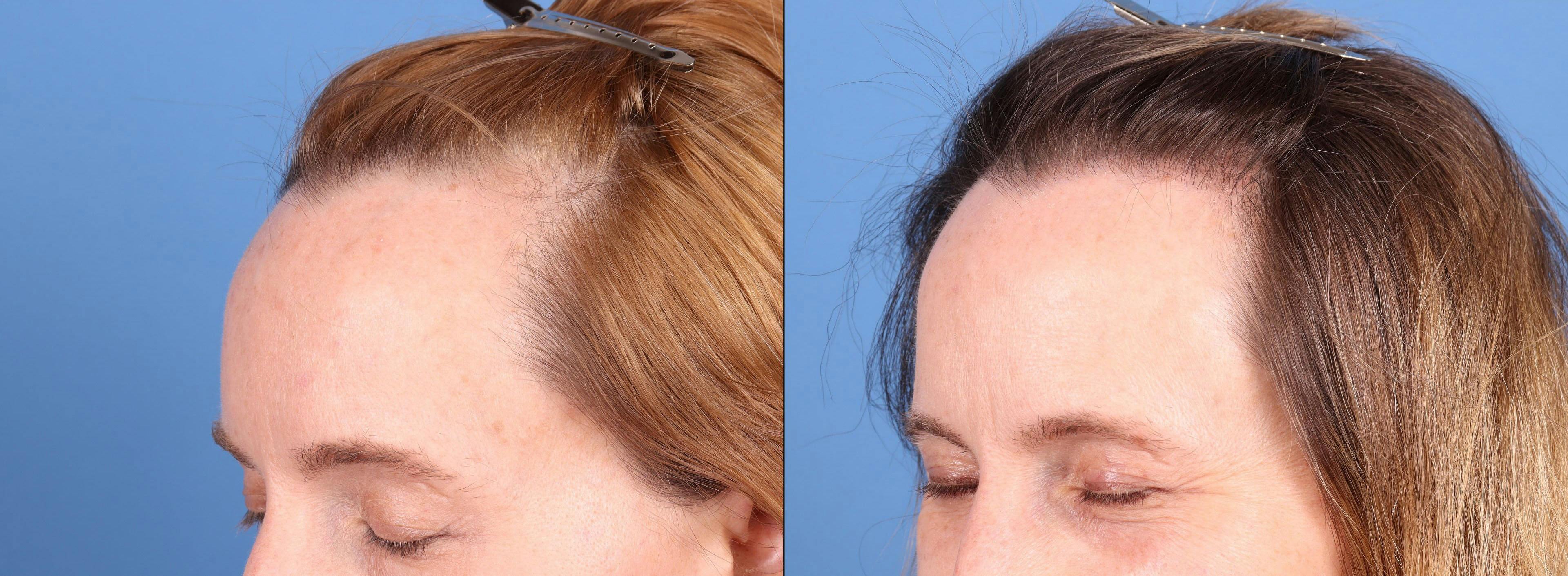NeoGraft Hair Restoration Before & After Gallery - Patient 748806 - Image 1