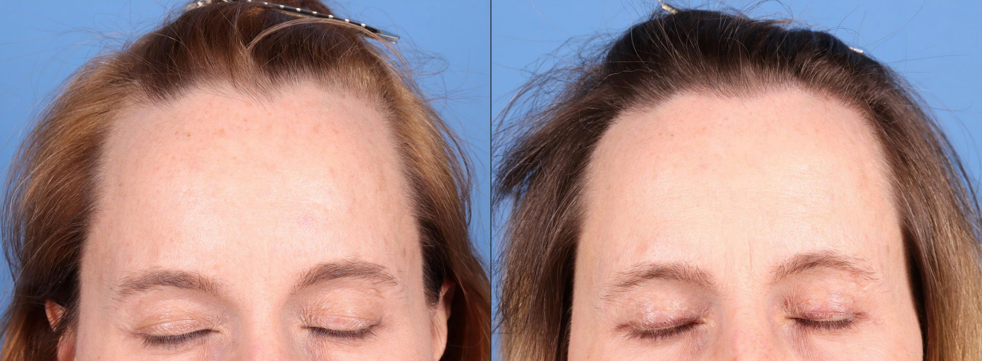 NeoGraft Hair Restoration Before & After Gallery - Patient 748806 - Image 2