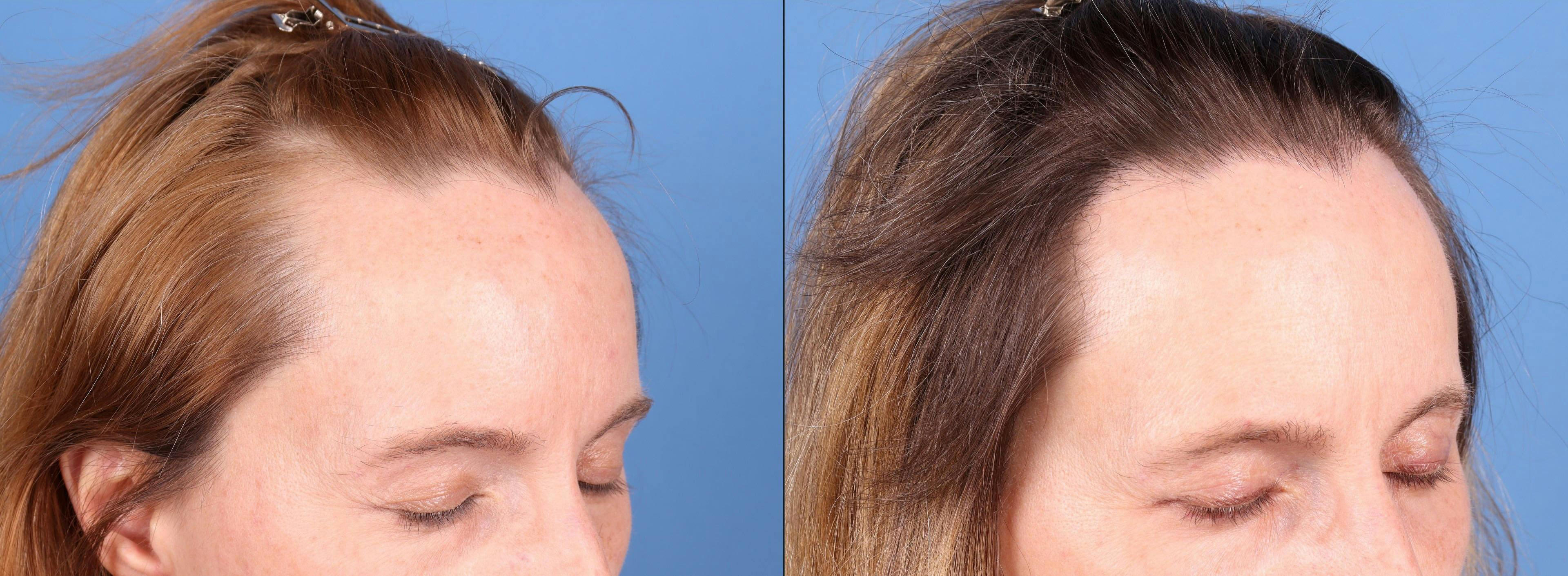 NeoGraft Hair Restoration Before & After Gallery - Patient 748806 - Image 3