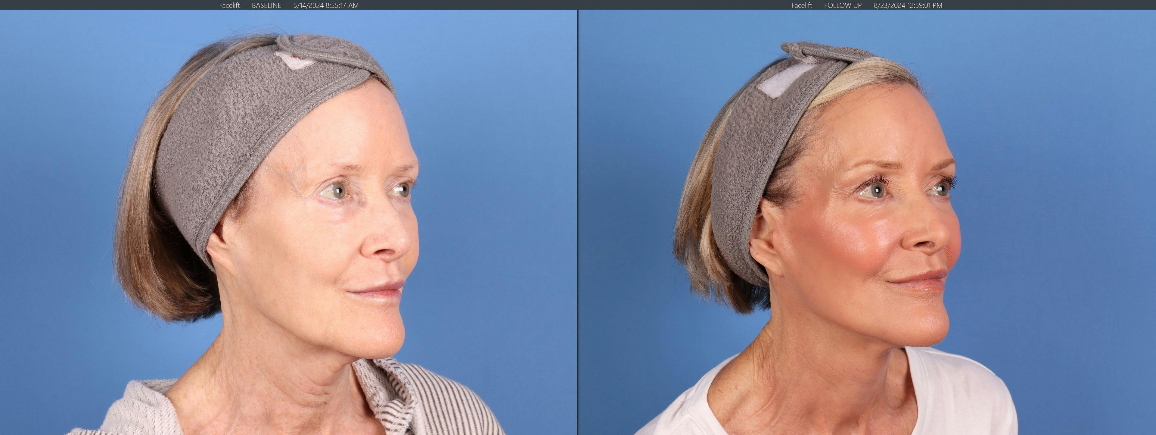 Neck Lift Before & After Gallery - Patient 398805 - Image 4