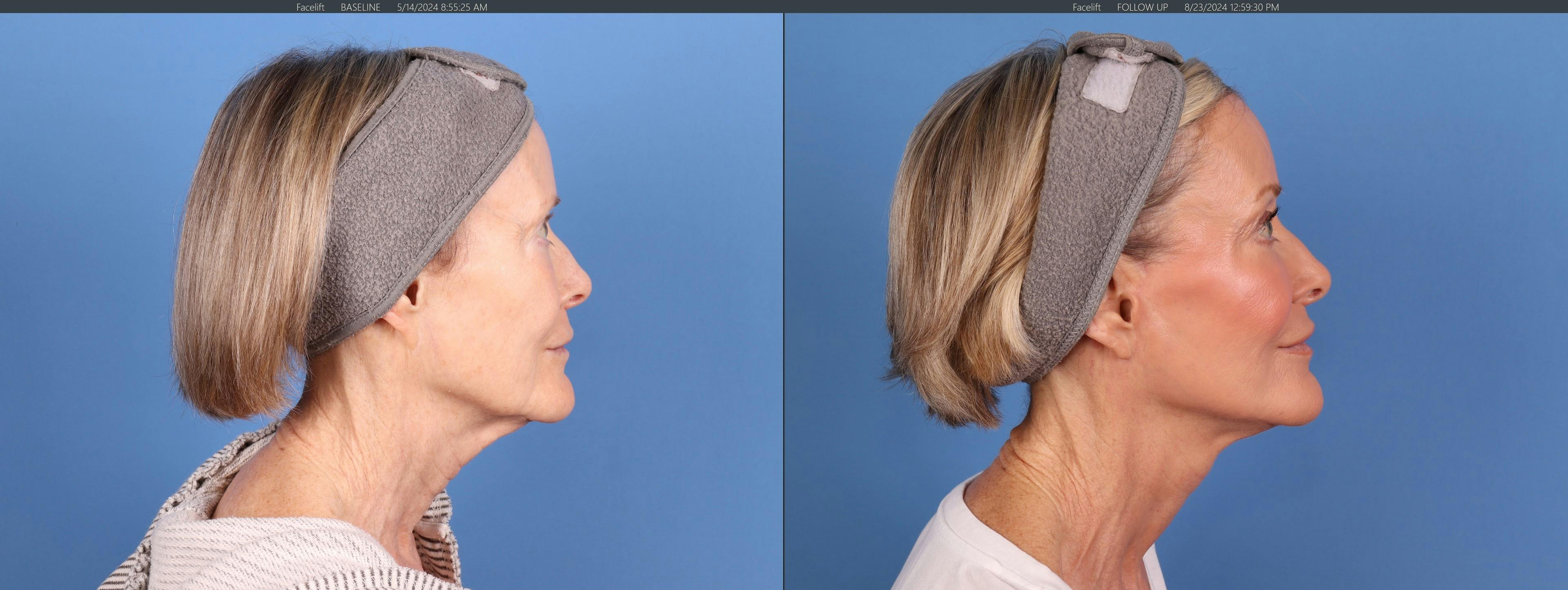 Neck Lift Before & After Gallery - Patient 398805 - Image 5