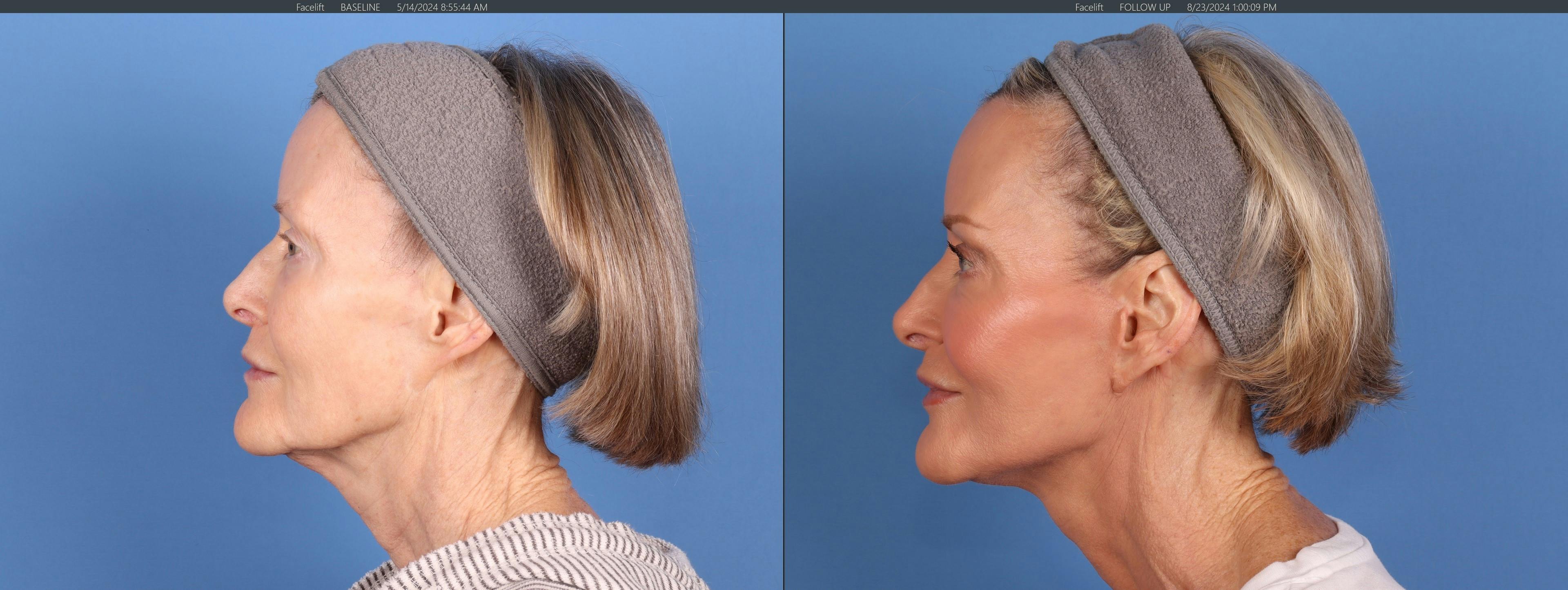 Neck Lift Before & After Gallery - Patient 398805 - Image 1