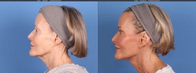 Neck Lift Before & After Gallery - Patient 398805 - Image 1