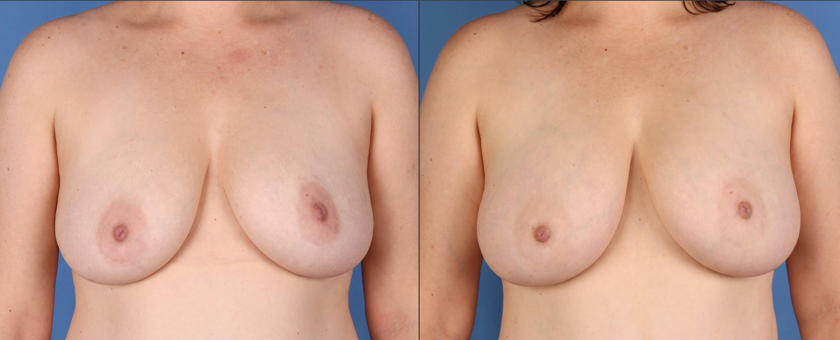 Fat Transfer Breast Augmentation Before & After Gallery - Patient 236788 - Image 1