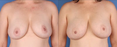 Fat Transfer Breast Augmentation Before & After Gallery - Patient 236788 - Image 1