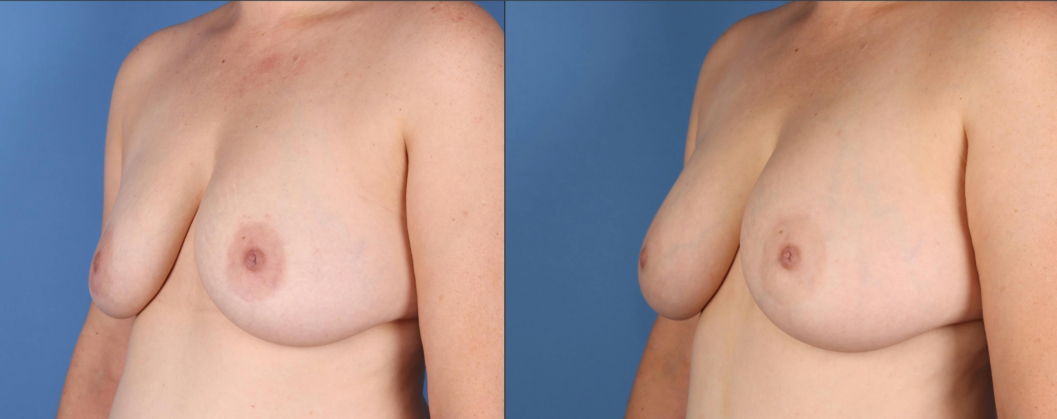 Fat Transfer Breast Augmentation Before & After Gallery - Patient 236788 - Image 2