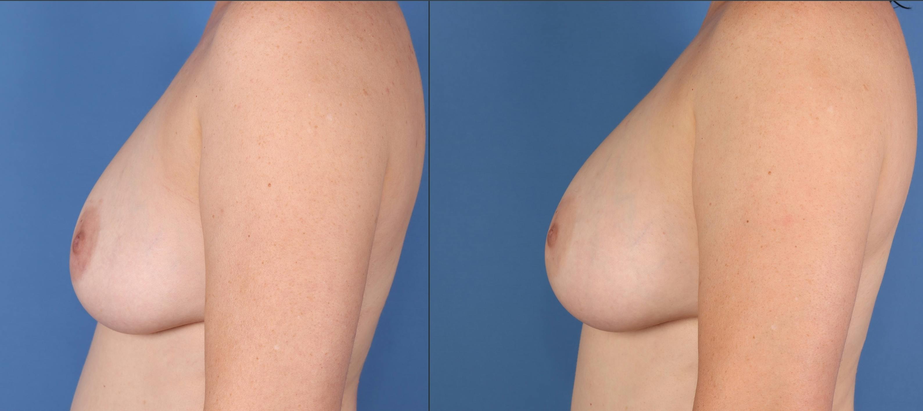 Fat Transfer Breast Augmentation Before & After Gallery - Patient 236788 - Image 3