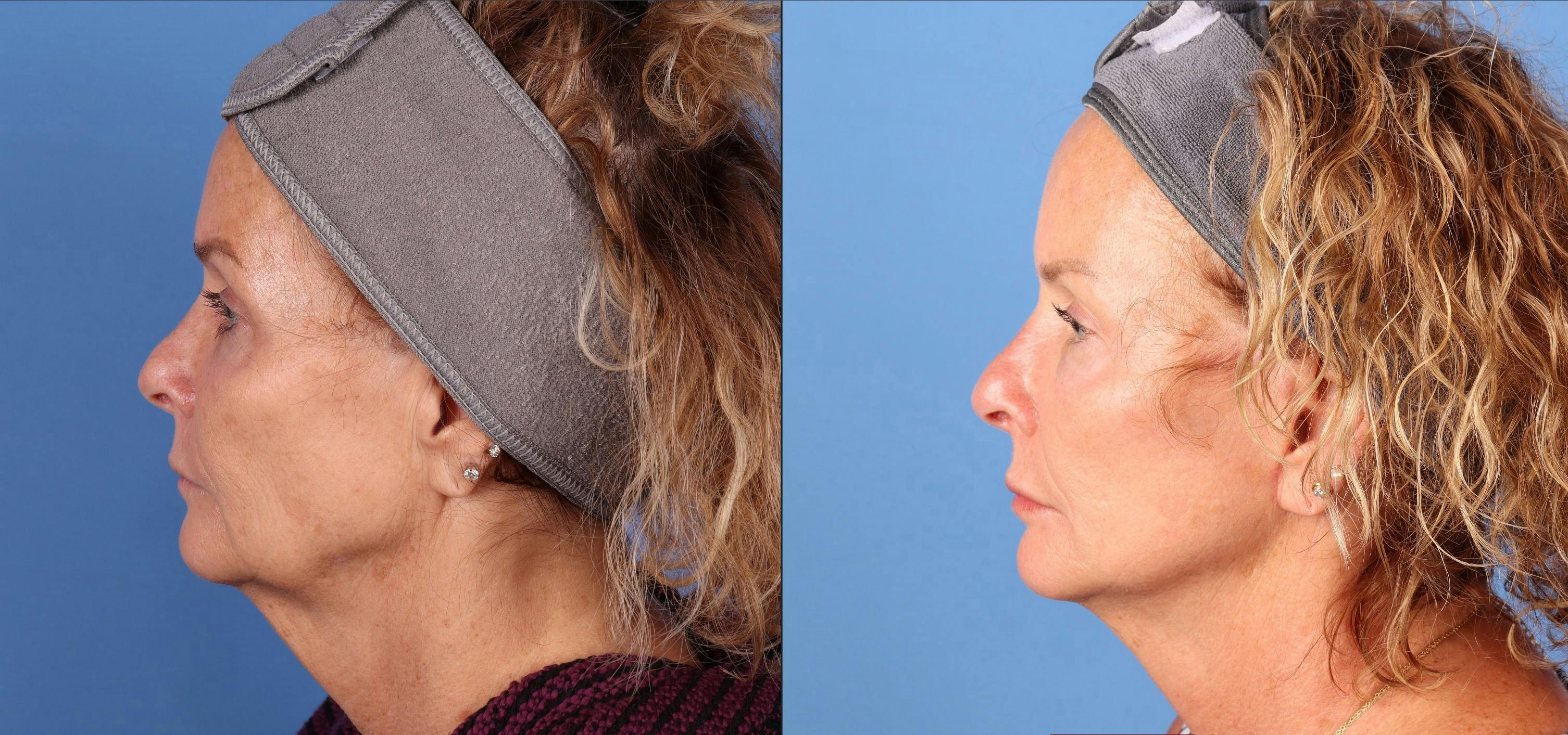 Mini Facelift Before & After Gallery - Patient 135738 - Image 3