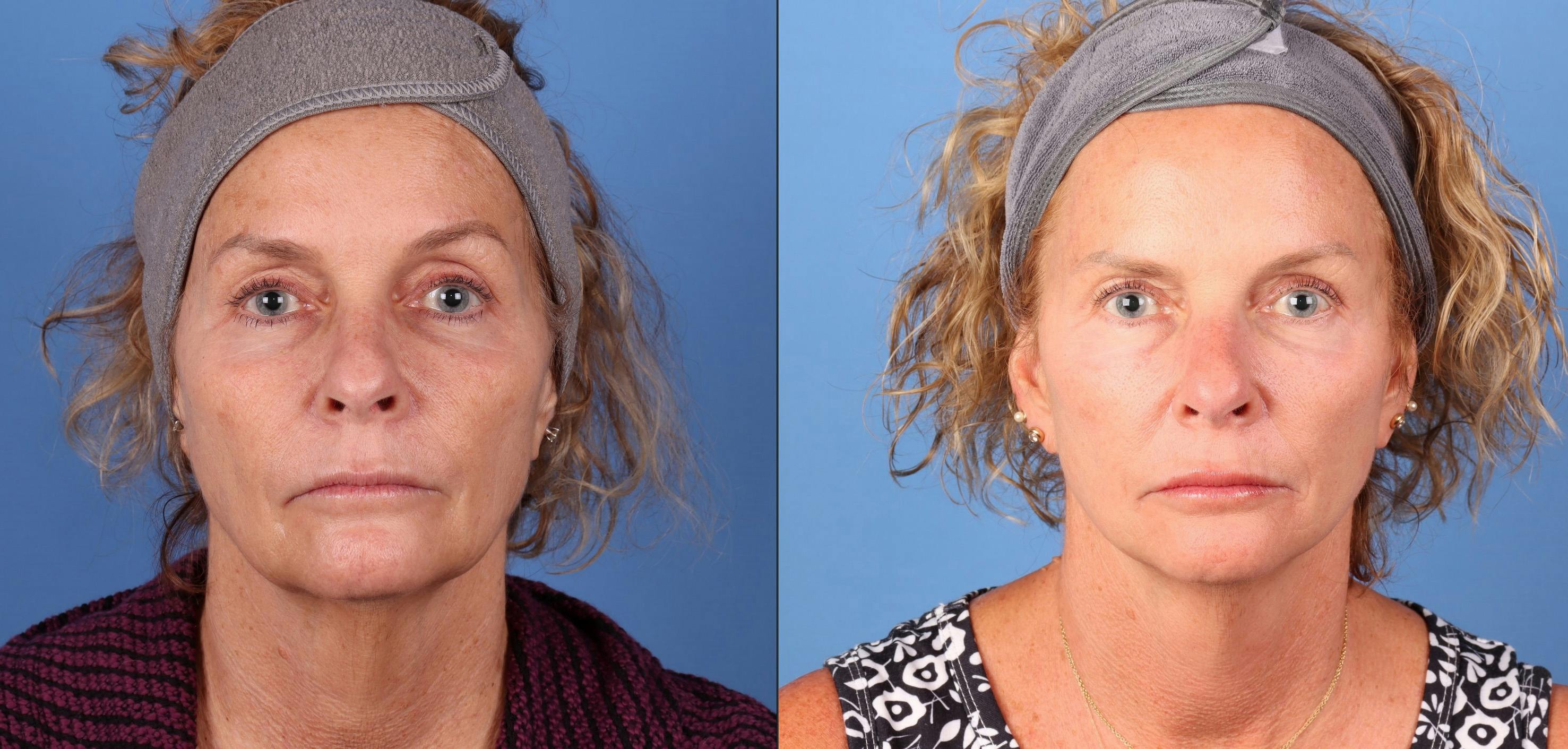 Mini Facelift Before & After Gallery - Patient 135738 - Image 1