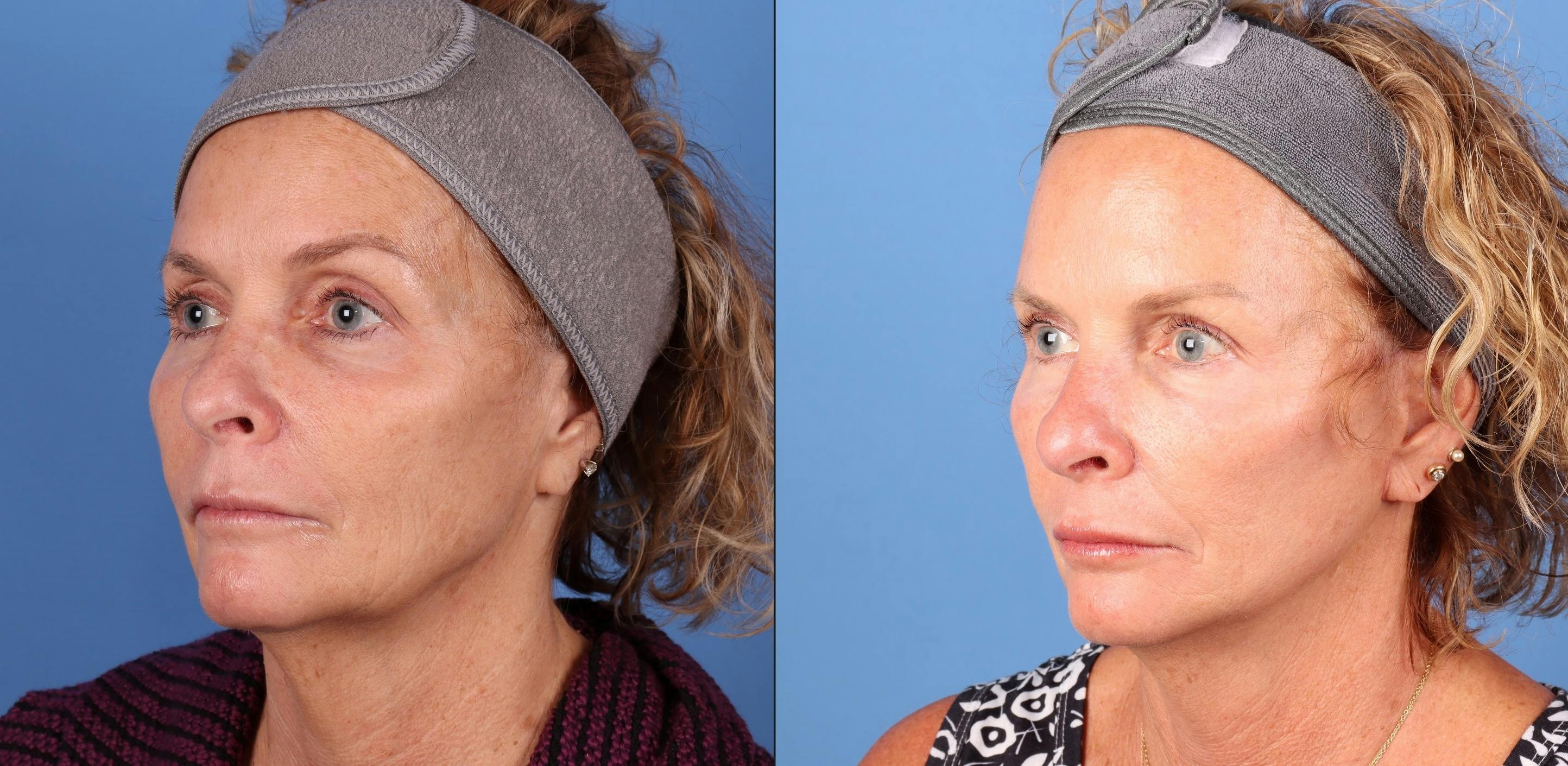 Mini Facelift Before & After Gallery - Patient 135738 - Image 2