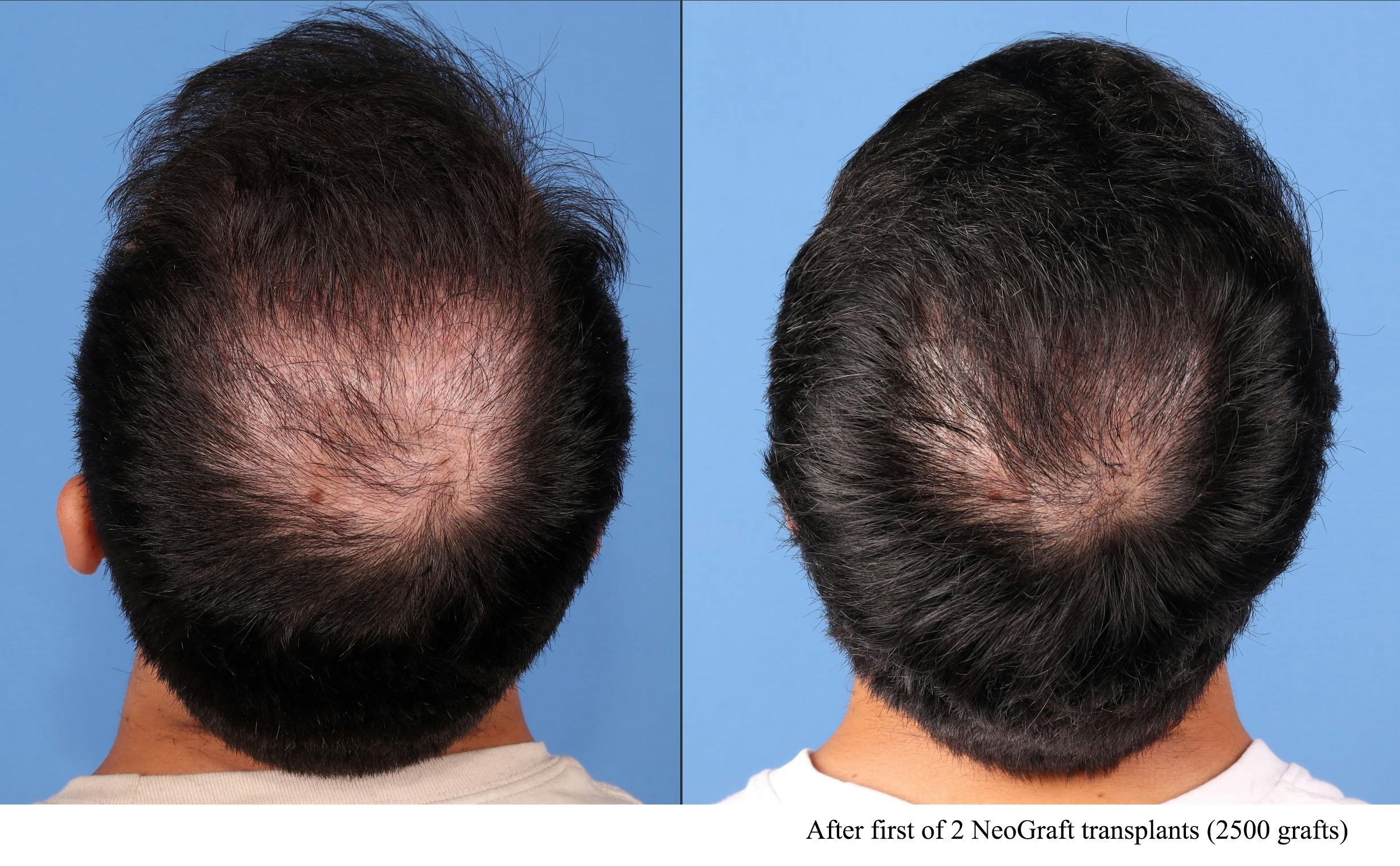 NeoGraft Hair Restoration Before & After Gallery - Patient 903626 - Image 1