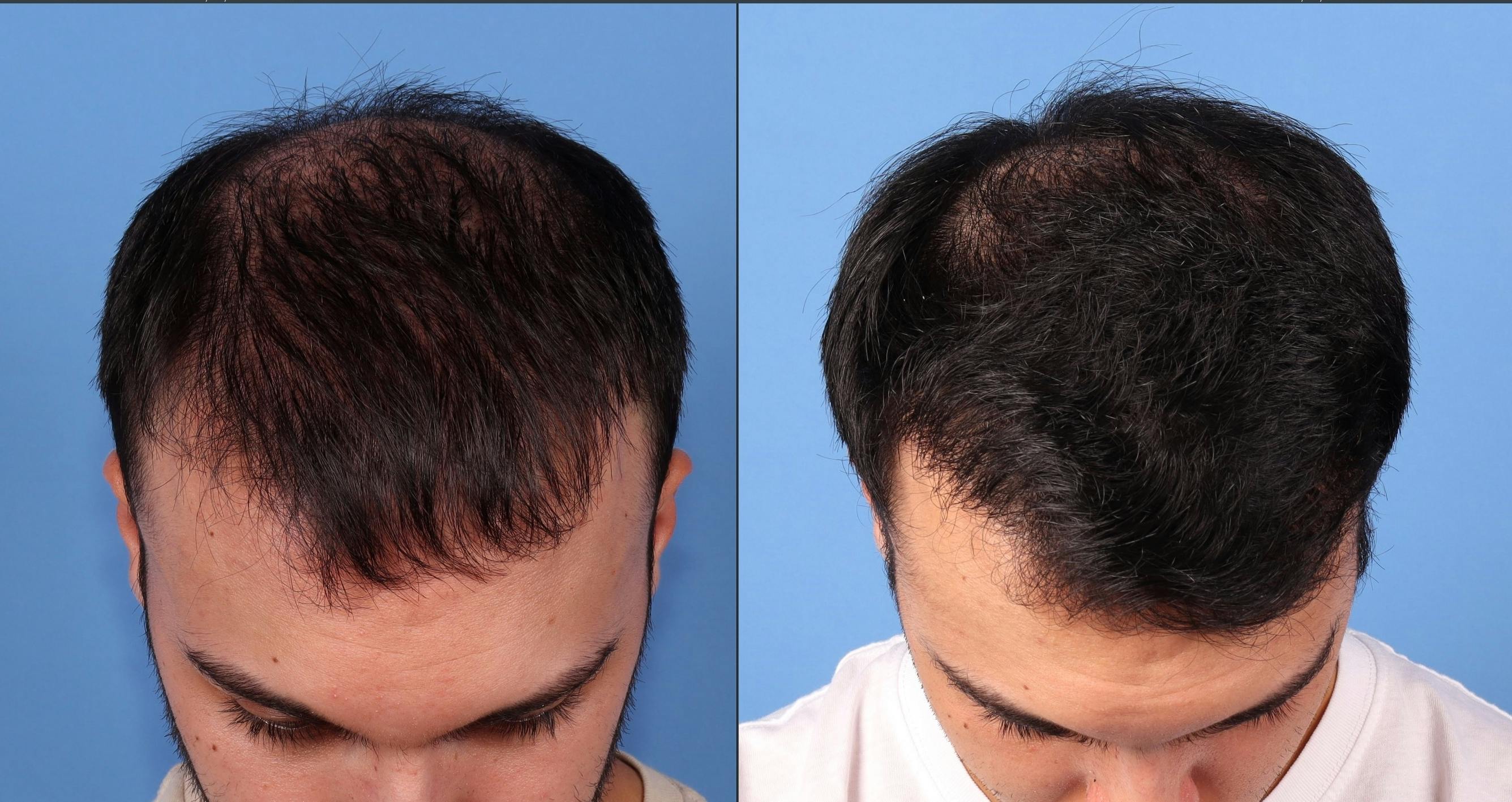 NeoGraft Hair Restoration Before & After Gallery - Patient 903626 - Image 2