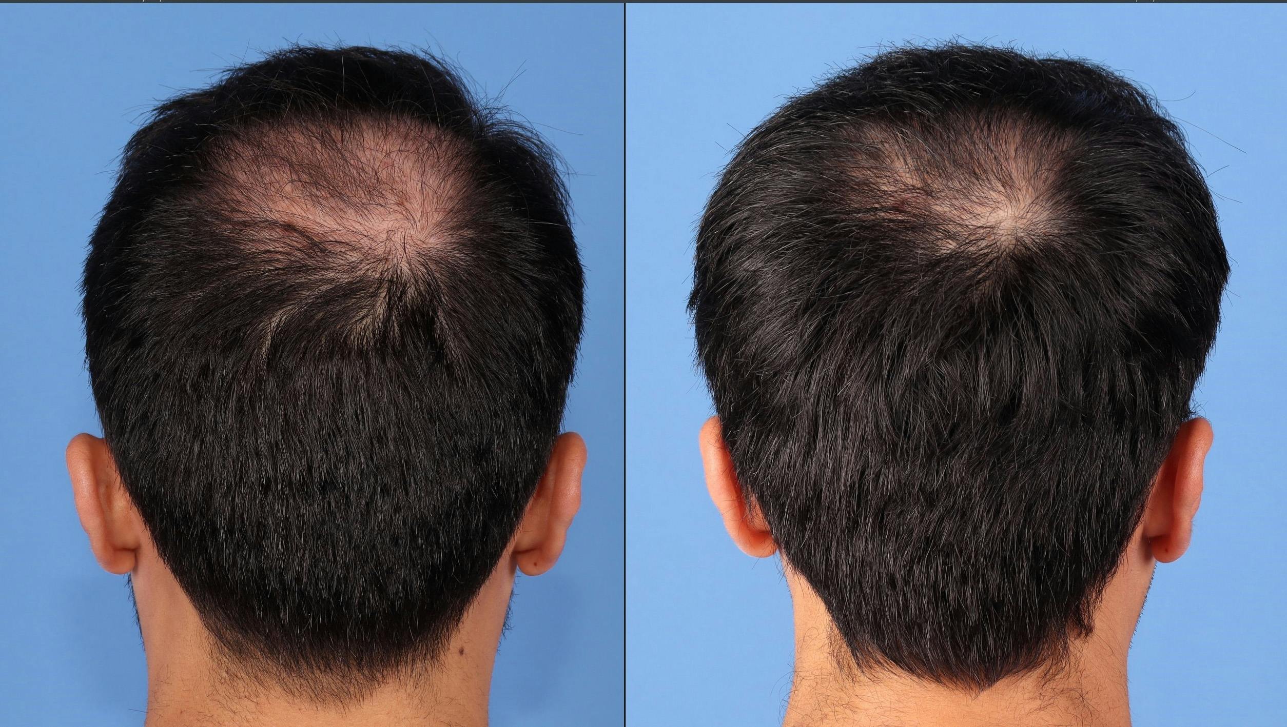 NeoGraft Hair Restoration Before & After Gallery - Patient 903626 - Image 4