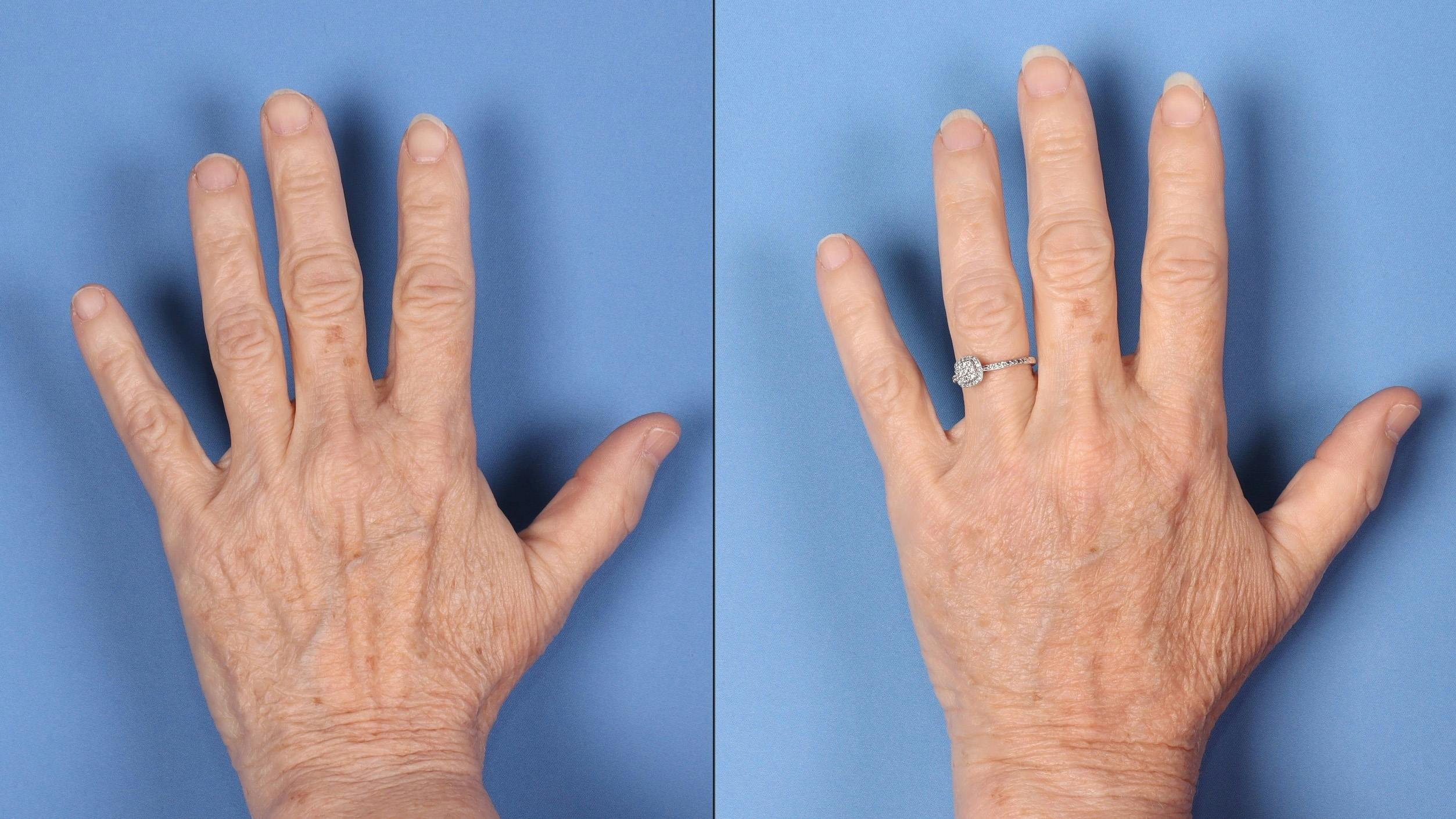 Fat Grafting to Hands Before & After Gallery - Patient 657160 - Image 1